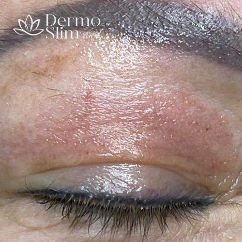 Resultado 2 depois do tratamento